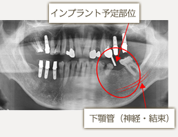 インプラント手術前検査