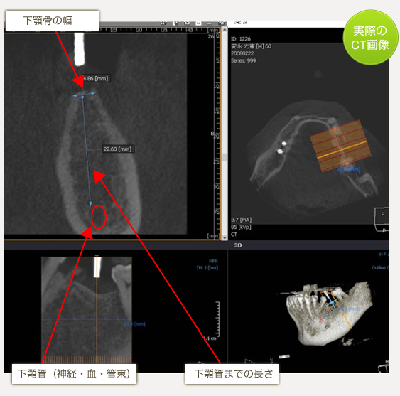 インプラント手術前検査