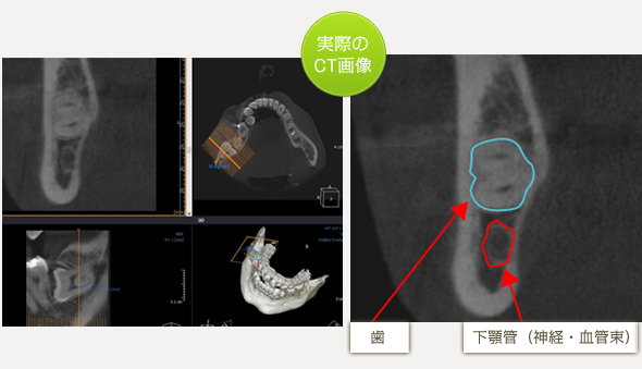親知らず(智歯)
