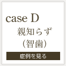 親知らず(智歯)