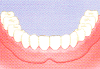 歯が全て無くなった場合