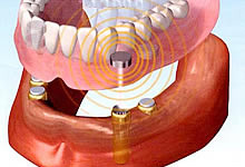 歯が全て無くなった場合