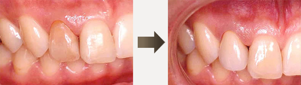 審美歯科　症例