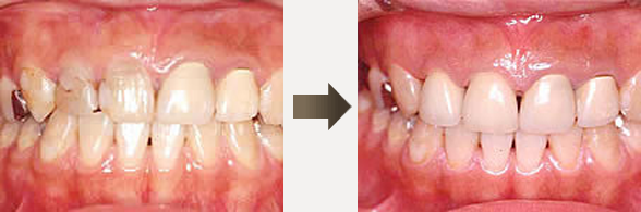 審美歯科　症例