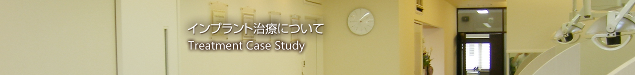 インプラント治療について