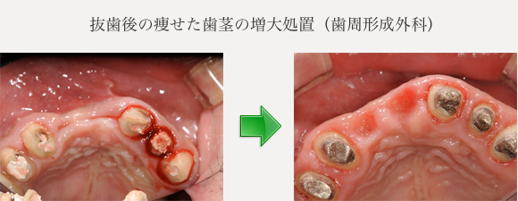 抜歯後の痩せた歯茎の増大処置（歯周形成外科）
