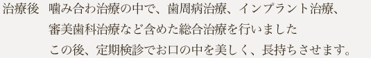 噛み合わせ治療の中で、歯周病治療、インプラント治療、審美歯科治療など含めた総合治療を行いましたこの後、定期検診でお口の中を美しく、長持ちさせます。