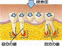 弱った歯を助けるインプラント