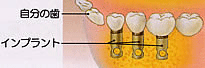 弱った歯を助けるインプラント