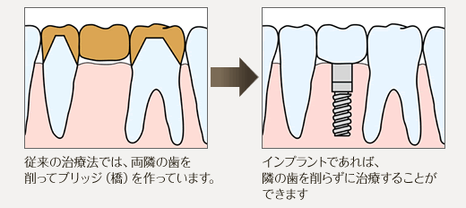 従来の治療法では、両隣の歯を削ってブリッジ（橋）を作っています。インプラントであれば、隣の歯を削らずに治療することができます