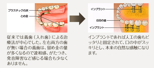 .左右両方の奥歯が無い場合