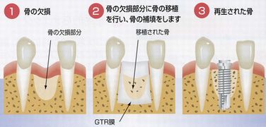 骨造成（GBR）