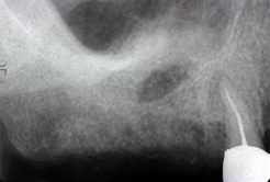上顎洞内の骨造成（サイナスリフト）