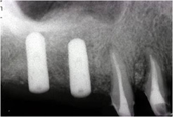 上顎洞内の骨造成（サイナスリフト）