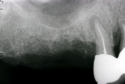 上顎洞内の骨造成（サイナスリフト）