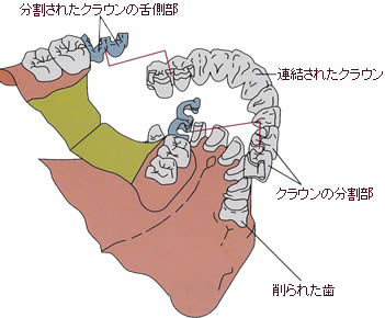 テレスコープ義歯