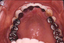 テレスコープ義歯症例