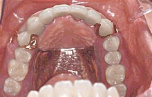 テレスコープ義歯症例