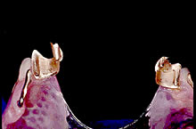 テレスコープ義歯症例