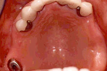 テレスコープ義歯症例