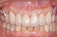 テレスコープ義歯症例