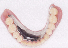 磁石義歯症例３（インプラント磁石義歯タイプ）