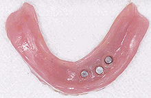 磁石義歯症例３（インプラント磁石義歯タイプ）