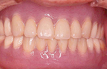 磁石義歯症例３（インプラント磁石義歯タイプ）