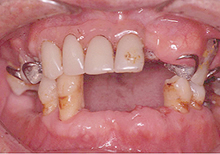 磁石義歯症例２（総義歯タイプ）