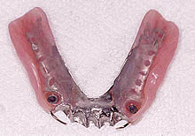 磁性アタッチメント義歯（磁石義歯）