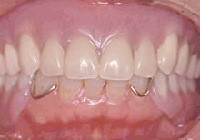 磁性アタッチメント義歯（磁石義歯）