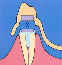磁性アタッチメント義歯（磁石義歯）