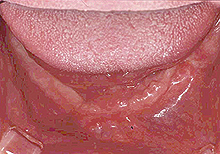 磁石義歯症例３（インプラント磁石義歯タイプ）