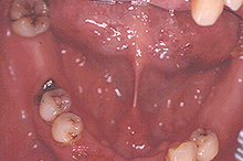 磁石義歯症例２（総義歯タイプ）