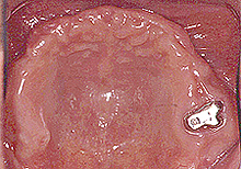 磁石義歯症例２（総義歯タイプ）