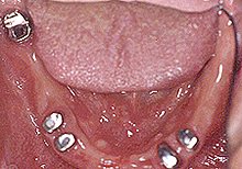 磁石義歯症例２（総義歯タイプ）