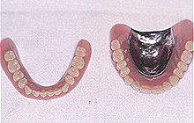 磁石義歯症例２（総義歯タイプ）