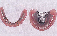 磁石義歯症例２（総義歯タイプ）