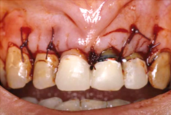 歯周形成外科（歯冠長延長術）。